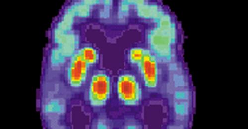 Alzheimer's may have once spread from person to person, but the risk of that happening today is incredibly low
